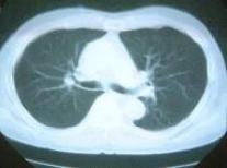 肺のヘリカルCT